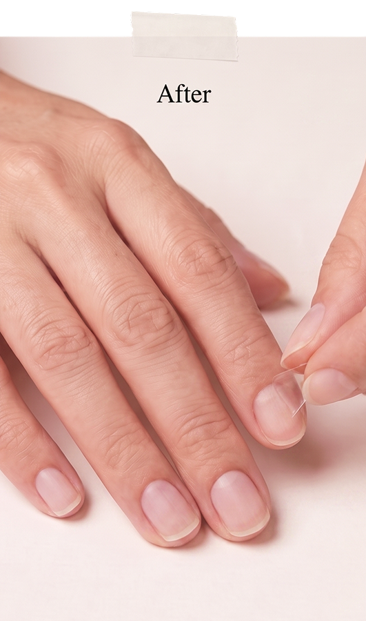 After: the same hands months later — bare, healthy nails, a tab peeling off clean