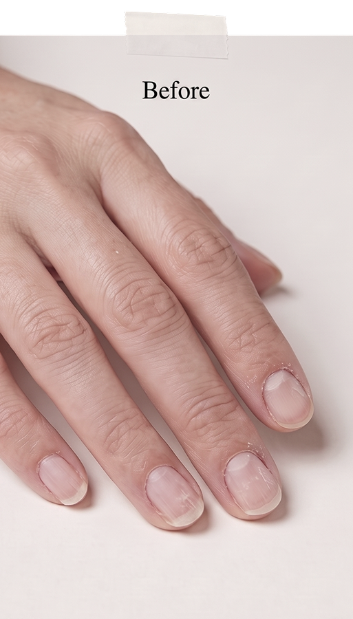 Before: her natural nails after the acrylics — thin, ridged, red at the edges